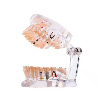 ৩২ দাঁত সম্পূর্ণ মাসের ইমপ্লান্ট রোগ দাঁত মডেল পরিষ্কার ডিজাইন ডেন্টাল প্যাথলজি মডেল